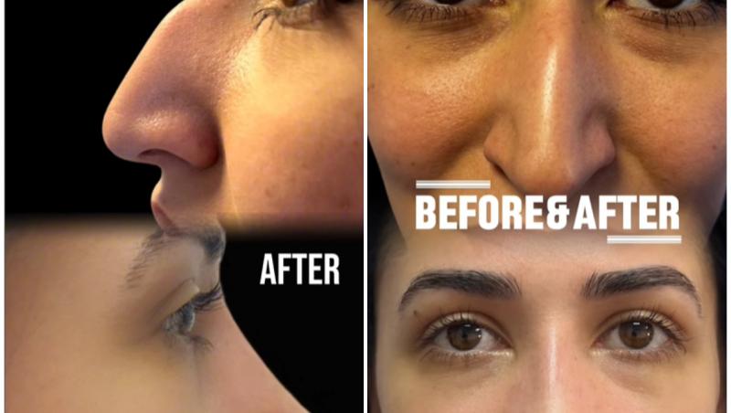 Mireasa, sezon 8. Cum arată Bogdana după operația de rinoplastie. Tânăra a renunțat la bandaje și se bucură de noua sa înfățișare