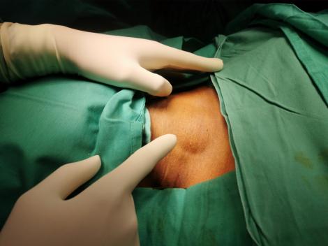 Ce este lipomul. Cauze și tratamente pentru lipom