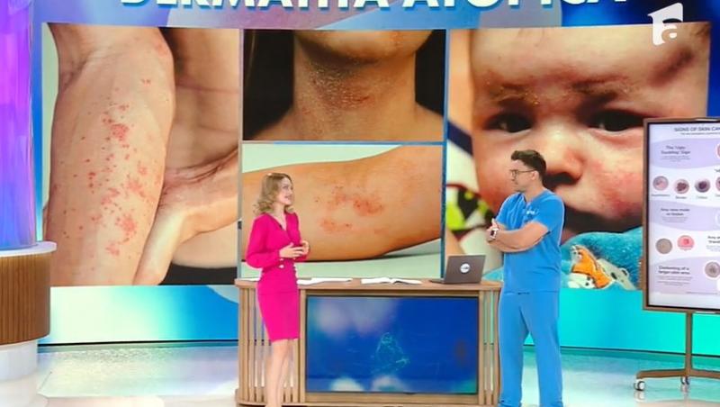 MediCOOL sezonul 8, 5 aprilie. Cauze și tratament pentru dermatita atopică. Recomandările medicului dermatolog Dana Bratu
