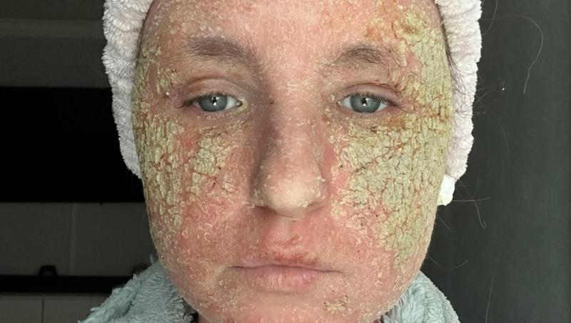 Tânăra a luat un tratament puternic și s-a trezit cu o peliculă verde pe față. Ce i s-a întâmplat și cum arăta înainte
