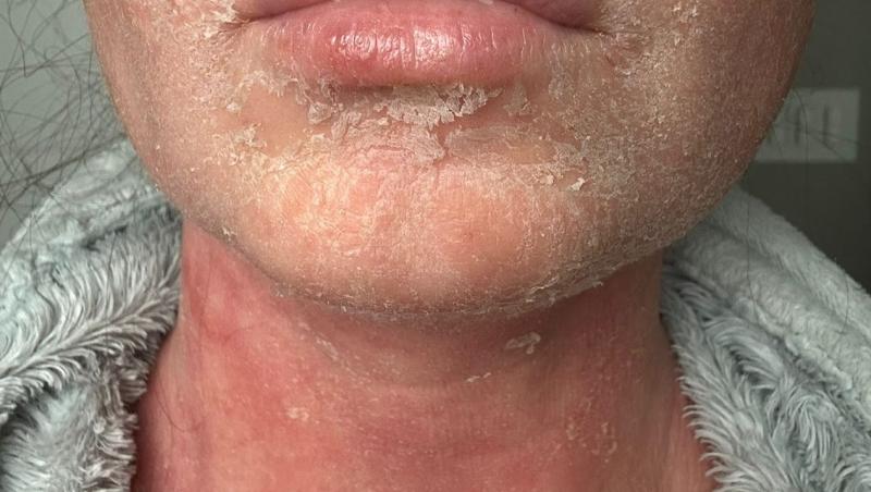 Tânăra a luat un tratament puternic și s-a trezit cu o peliculă verde pe față. Ce i s-a întâmplat și cum arăta înainte