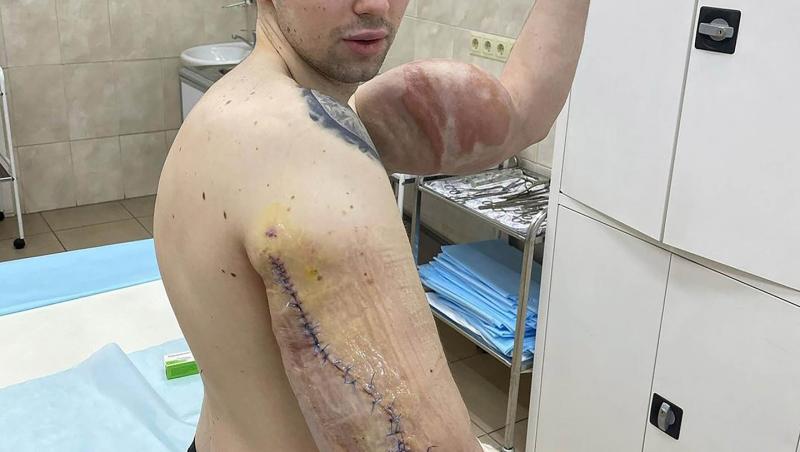 „Popeye”, tânărul care și-a injectat ulei în brațe ca să impresioneze pe internet, a ajuns la spital: „Cum vei câștiga bani acum?”