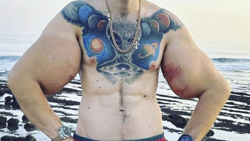 „Popeye”, tânărul care și-a injectat ulei în brațe ca să impresioneze pe internet, a ajuns la spital: „Cum vei câștiga bani acum?”