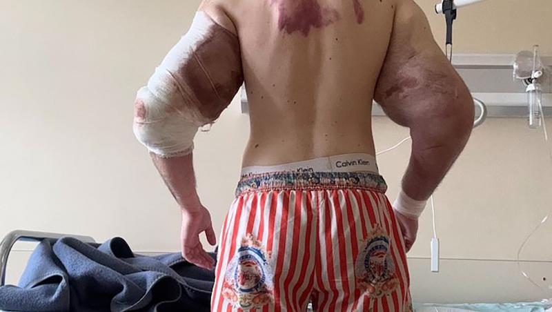 „Popeye”, tânărul care și-a injectat ulei în brațe ca să impresioneze pe internet, a ajuns la spital: „Cum vei câștiga bani acum?”