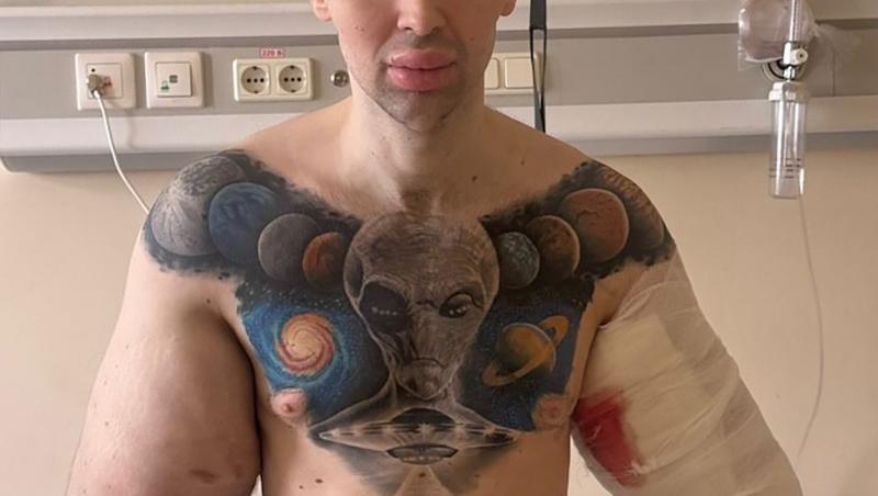 „Popeye”, tânărul care și-a injectat ulei în brațe ca să impresioneze pe internet, a ajuns la spital: „Cum vei câștiga bani acum?”