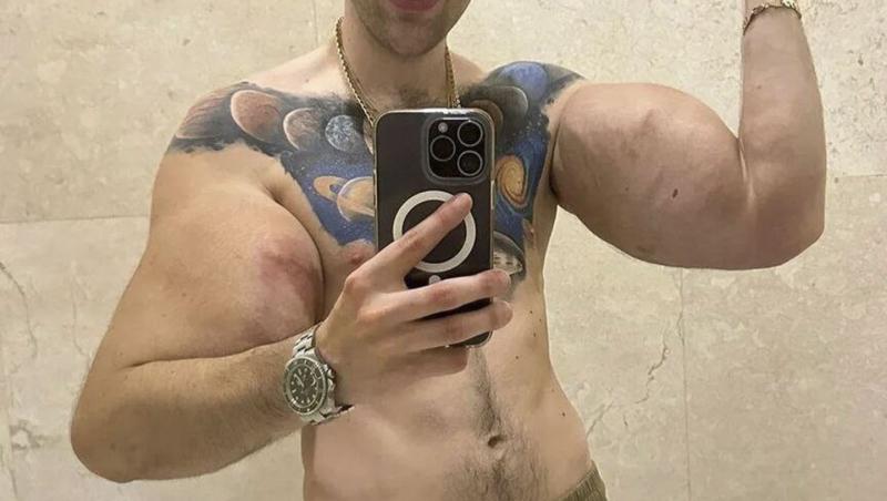 „Popeye”, tânărul care și-a injectat ulei în brațe ca să impresioneze pe internet, a ajuns la spital: „Cum vei câștiga bani acum?”