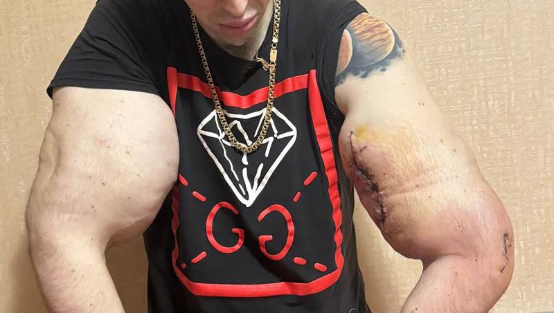 „Popeye”, tânărul care și-a injectat ulei în brațe ca să impresioneze pe internet, a ajuns la spital: „Cum vei câștiga bani acum?”