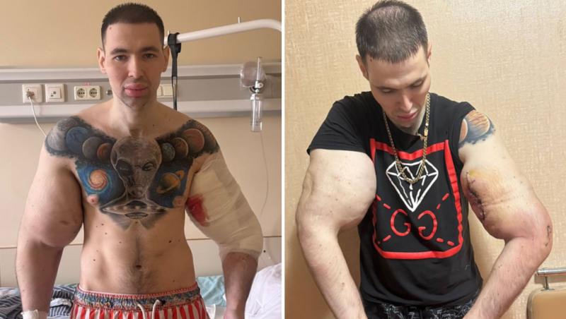 „Popeye”, tânărul care și-a injectat ulei în brațe ca să impresioneze pe internet, a ajuns la spital: „Cum vei câștiga bani acum?”
