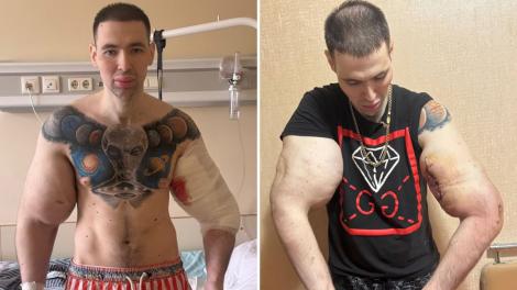 „Popeye”, tânărul care și-a injectat ulei în brațe ca să impresioneze pe internet, a ajuns la spital: „Cum vei câștiga bani acum?”