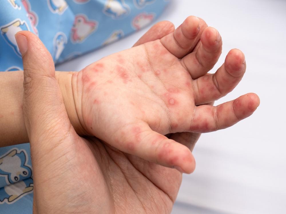 Boala mână-gură-picior: cauze, simptome si tratament
