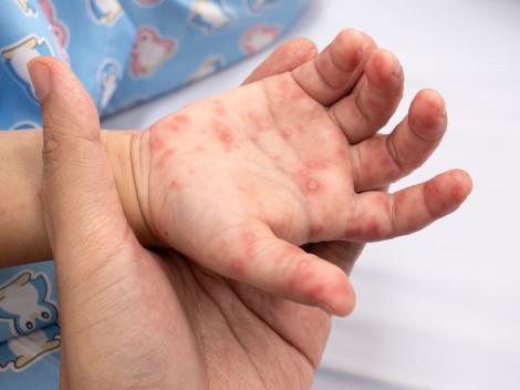 Boala mână-gură-picior: cauze, simptome si tratament