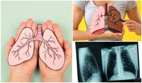 Cancerul pulmonar, un inamic tăcut. Simptomele ce arată că ești bolnav. Poți face boala dacă nu ai fumat? Află răspunsul