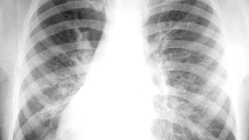 Cancerul pulmonar, un inamic tăcut. Simptomele ce arată că ești bolnav. Poți face boala dacă nu ai fumat? Află răspunsul