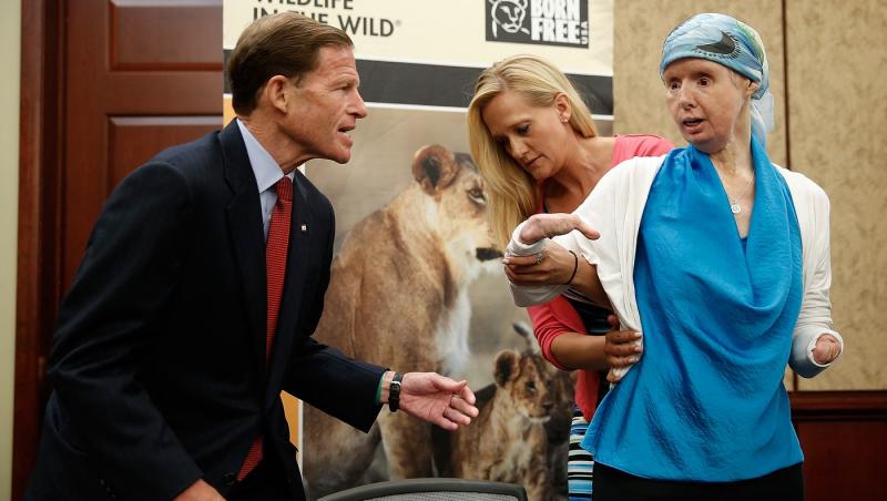 Un cimpanzeu i-a tumefiat față transfigurând-o complet. Cum arată femeia la 16 ani dupa transplantul de față