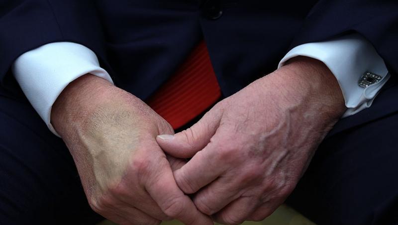 Donald Trump are o pată vizibilă pe mână, care pare acoperită cu fond de ten