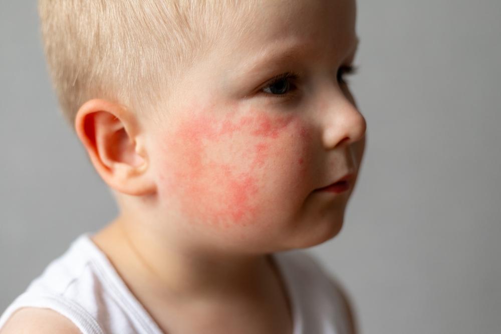 Eritemul infecțios sau boala obrajilor pălmuiți: cauze, simptome și tratament