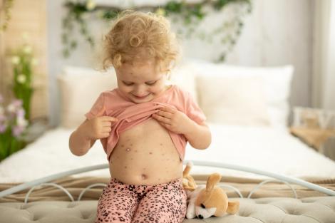 Varicela (vărsatul de vânt): simptome, tratament și complicații