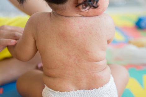 Roseola Infantum: ce este, cauze, simptome, tratament și îngrijire