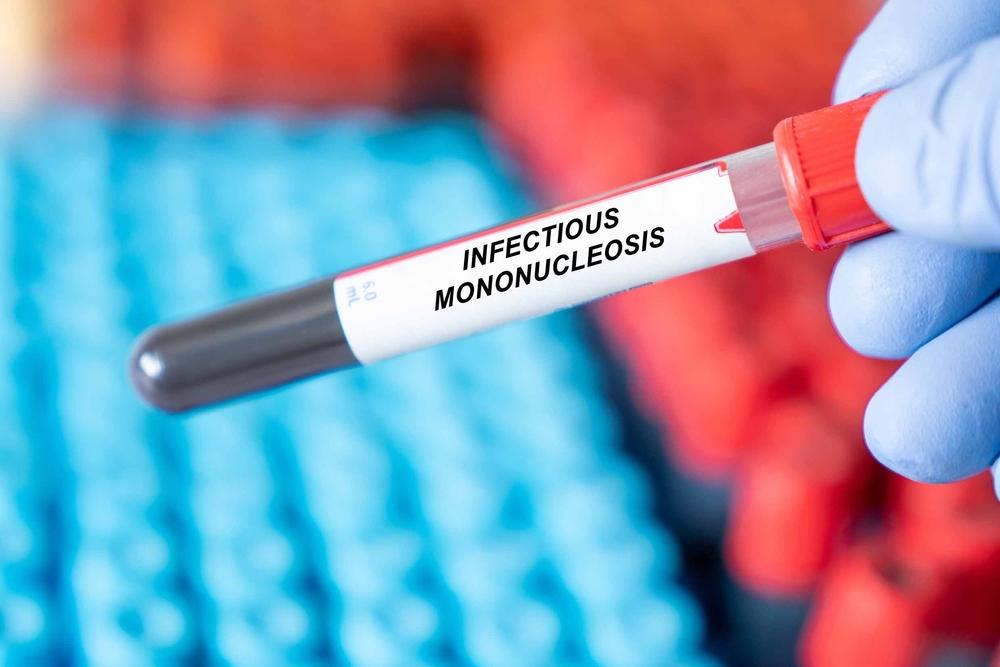 Mononucleoza infecțioasă (boala sărutului): cauze, simptome, tratament și complicații
