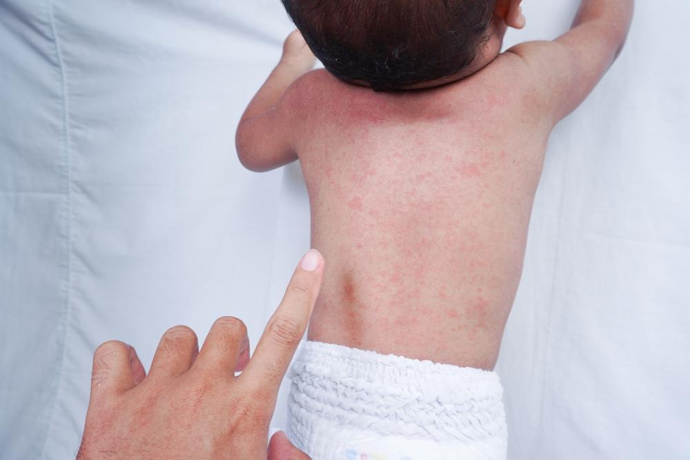 un bebeluș care stă pe burtă cu iritație de la căldură pe spate