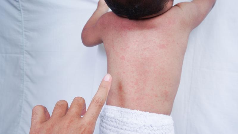 un bebeluș care stă pe burtă cu iritație de la căldură pe spate