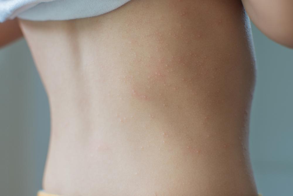 close up copil cu alergie de la caldura sub formă de vezicule albe pe spate