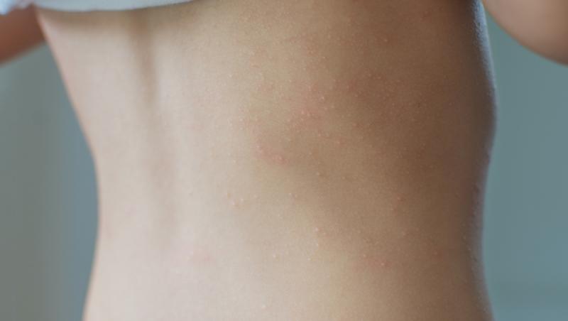 close up copil cu alergie de la caldura sub formă de vezicule albe pe spate