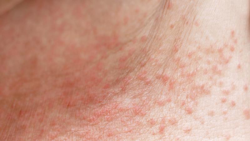 Când transpirația se acumulează în straturile mai profunde ale pielii, pot apărea forme mai severe de miliaria, care sunt mai greu de tratat