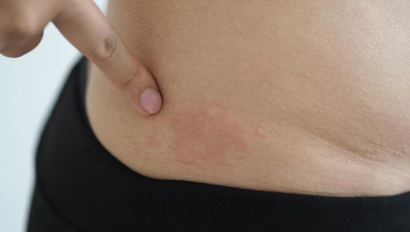 La adulți, este mai frecventă o formă de miliaria caracterizată prin bubițe roșii și inflamate