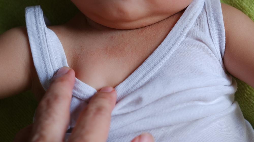 detaliu cu o iritație pe gâtul unui bebeluș