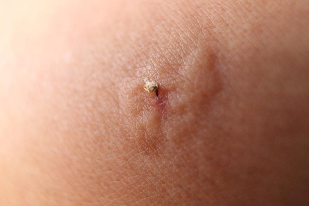 close up cu un ac de albină în piele și sacul cu venin