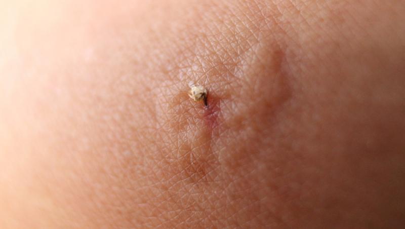 Când înțeapă, albinele își lasă acul în piele, iar sacul atașat continuă să elibereze venin