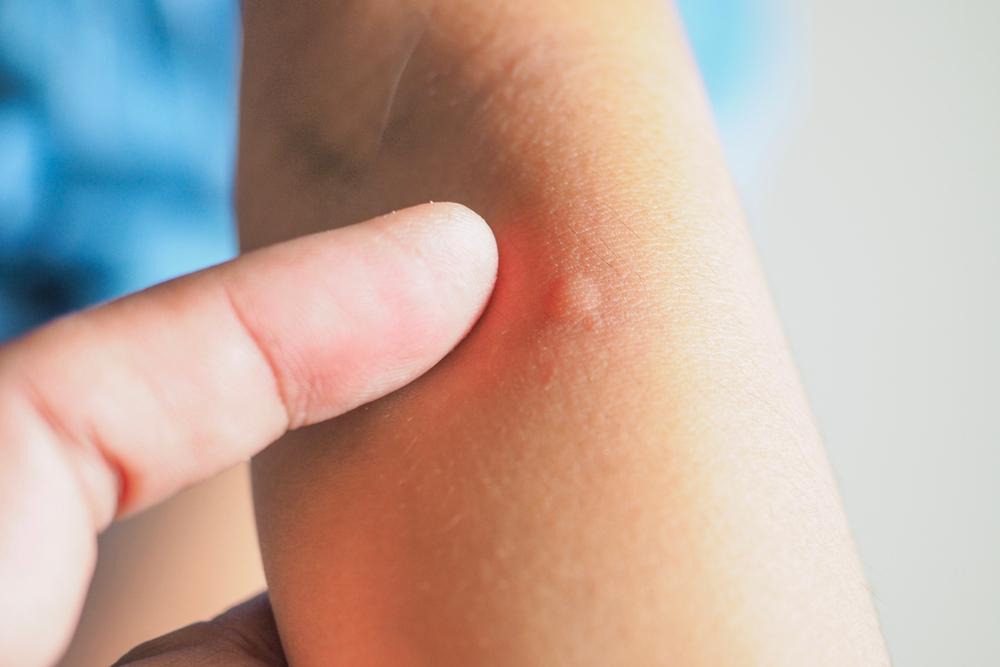 detaliu cu braț de copil cu înțepătură de furnică