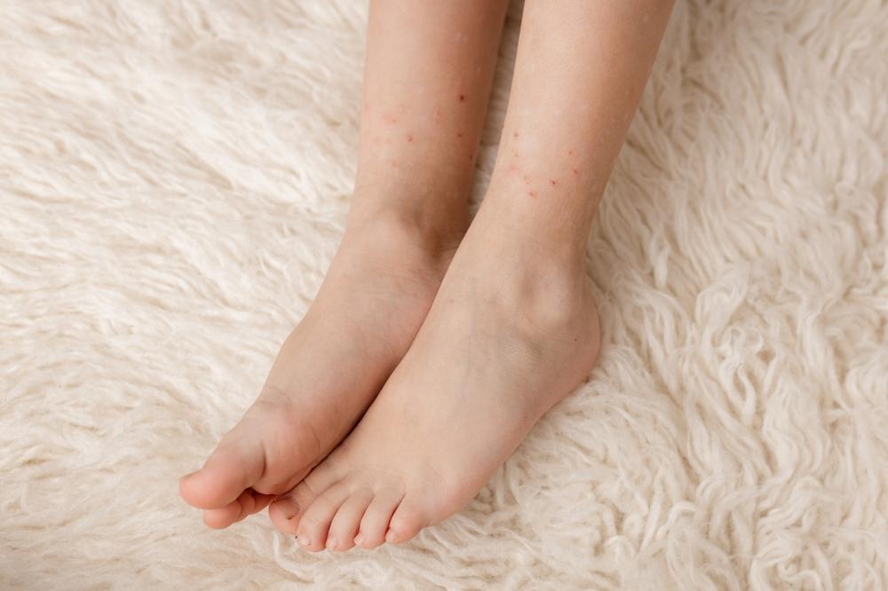 detaliu cu picioare de copil cu înțepături de purici