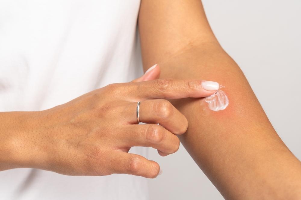 10 remedii naturale pentru mușcături de țânțari. Ce să aplici pe înțepături ca să scapi de disconfort