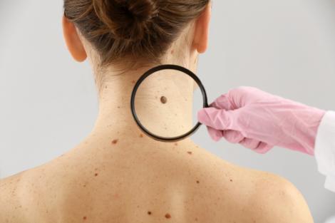 Cum pot radiațiile UV și expunerea la soare să provoace cancer