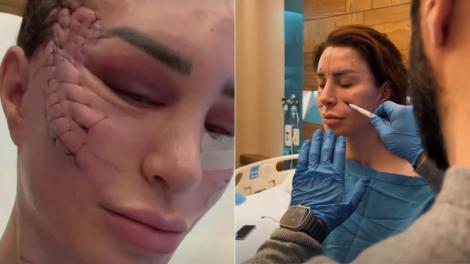 Femeia și-a dorit un lifting facial, dar a rămas cu niște cusături uriașe pe față. Cum arată acum tânăra după transformare