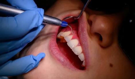 (P) Tratamentul cu antibiotic pentru abcesul dentar: când este necesar și ce opțiuni există