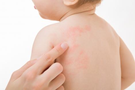 Eczema la bebeluși: lucruri pe care părinții trebuie să le știe