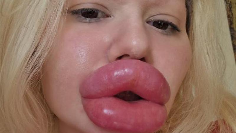 Femeia cu cele mai mari buze din lume a fost refuzată de stomatologi. De ce nu au vrut specialiștii să o trateze