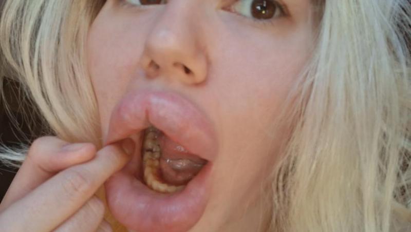 Femeia cu cele mai mari buze din lume a fost refuzată de stomatologi. De ce nu au vrut specialiștii să o trateze