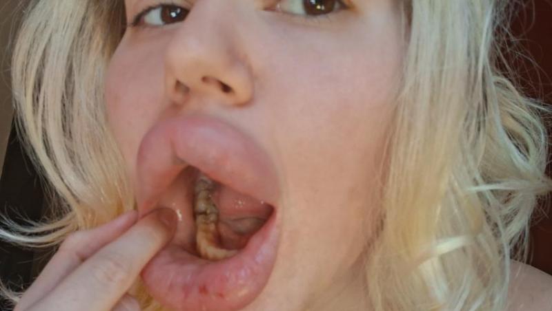 Femeia cu cele mai mari buze din lume a fost refuzată de stomatologi. De ce nu au vrut specialiștii să o trateze