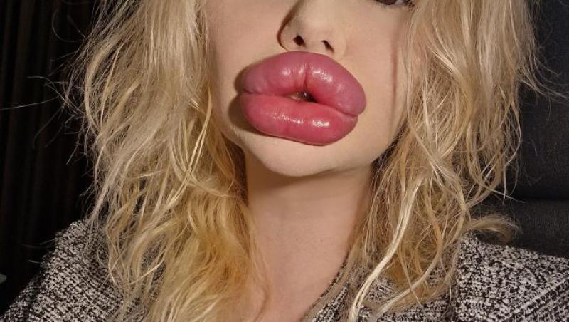 Femeia cu cele mai mari buze din lume a fost refuzată de stomatologi. De ce nu au vrut specialiștii să o trateze