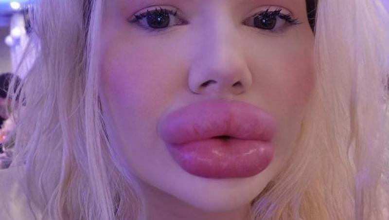 Femeia cu cele mai mari buze din lume a fost refuzată de stomatologi. De ce nu au vrut specialiștii să o trateze