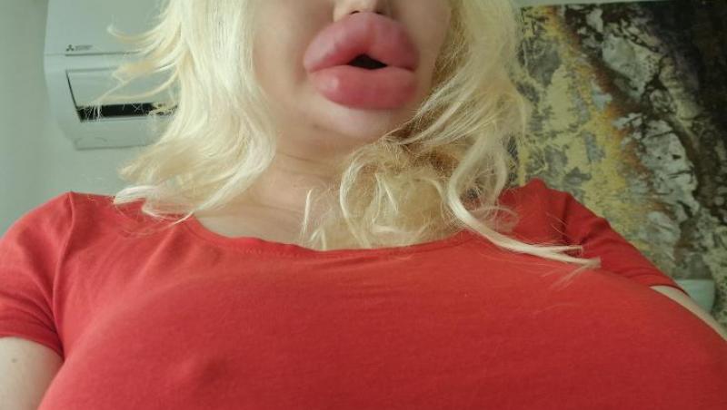 Femeia cu cele mai mari buze din lume a fost refuzată de stomatologi. De ce nu au vrut specialiștii să o trateze