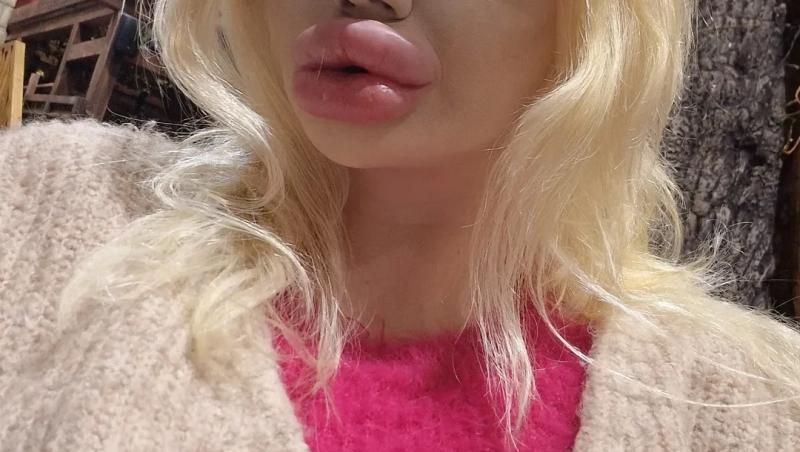 Femeia cu cele mai mari buze din lume a fost refuzată de stomatologi. De ce nu au vrut specialiștii să o trateze