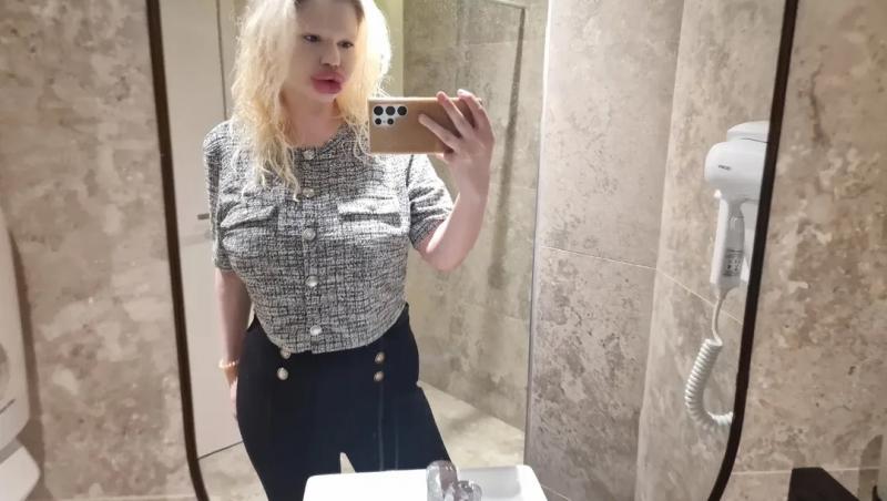 Femeia cu cele mai mari buze din lume a fost refuzată de stomatologi. De ce nu au vrut specialiștii să o trateze