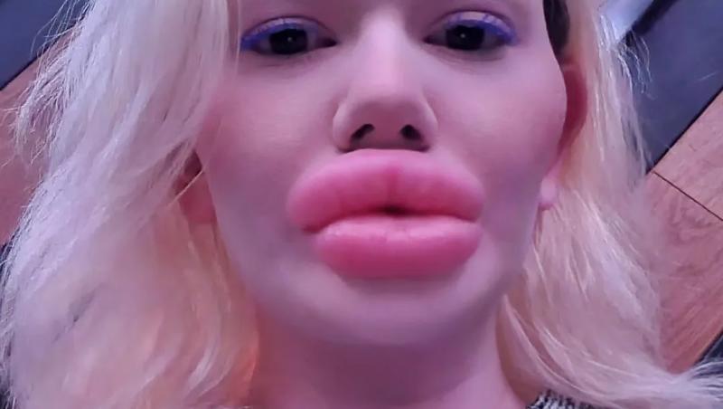 Femeia cu cele mai mari buze din lume a fost refuzată de stomatologi. De ce nu au vrut specialiștii să o trateze