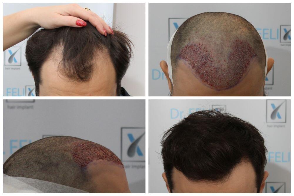 (P) Dr. Felix Hair Implant - clinica pentru implant de păr din București care schimbă vieți