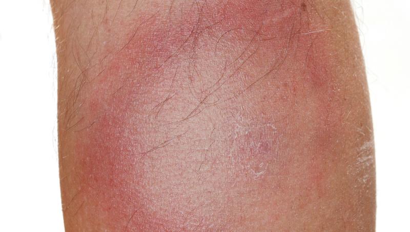 close up cu eritemul migrator specific bolii Lyme pe un picior